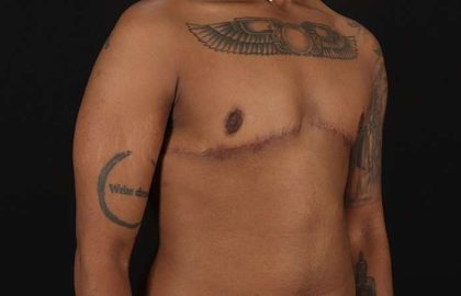 Female To Male Breast Before & After Patient #4053