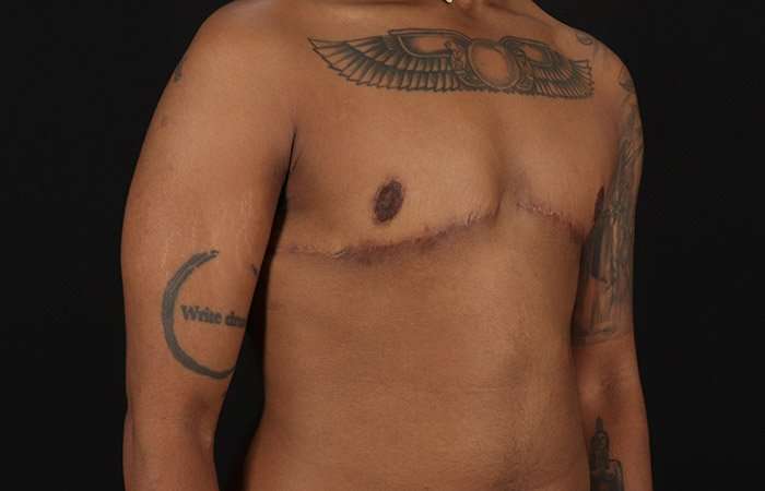 Female To Male Breast Before & After Patient #4053