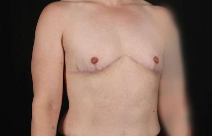Female To Male Breast Before & After Patient #4064