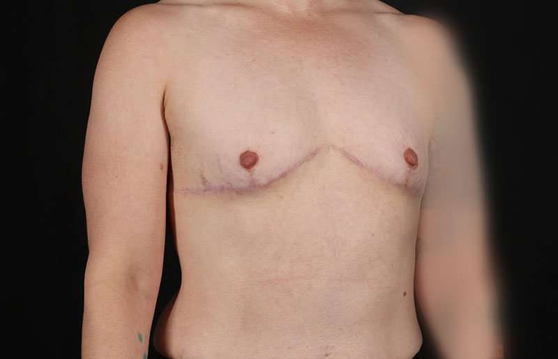 Female To Male Breast Before & After Patient #4064