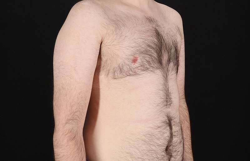 Female To Male Breast Before & After Patient #4075
