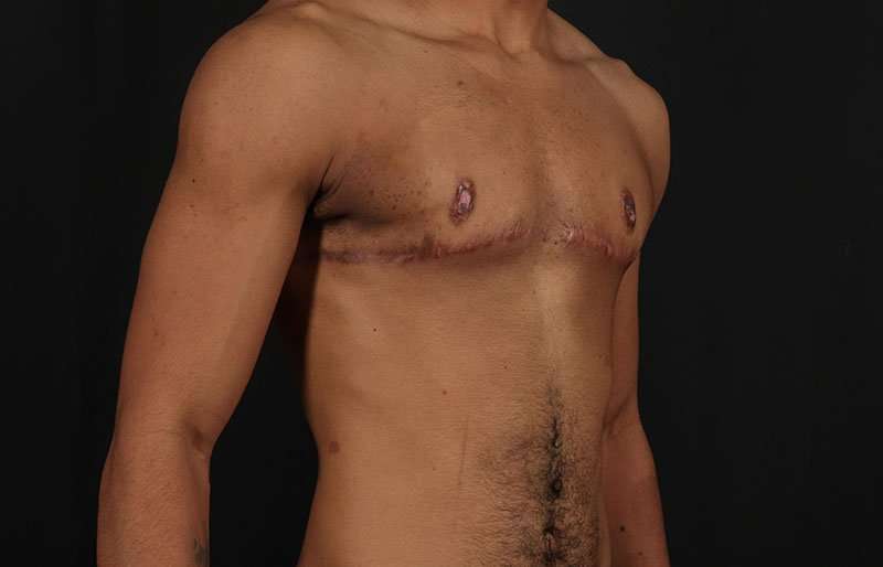 Female To Male Breast Before & After Patient #4086