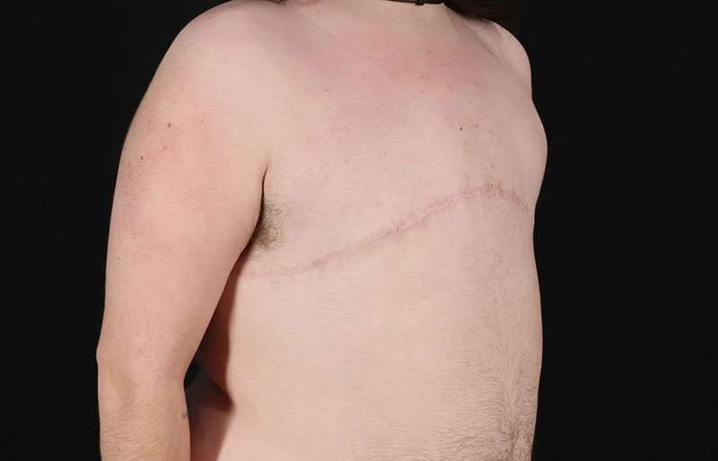 Female To Male Breast Before & After Patient #4097