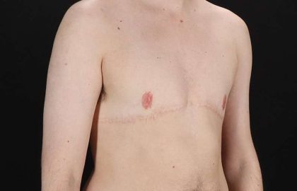 Female To Male Breast Before & After Patient #4108