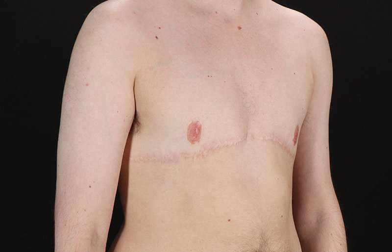 Female To Male Breast Before & After Patient #4108