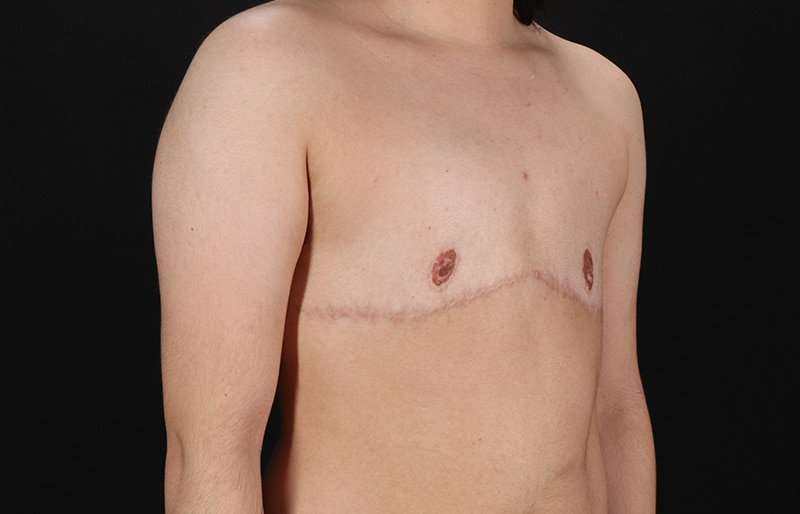Female To Male Breast Before & After Patient #4119