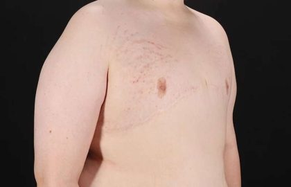 Female To Male Breast Before & After Patient #4130