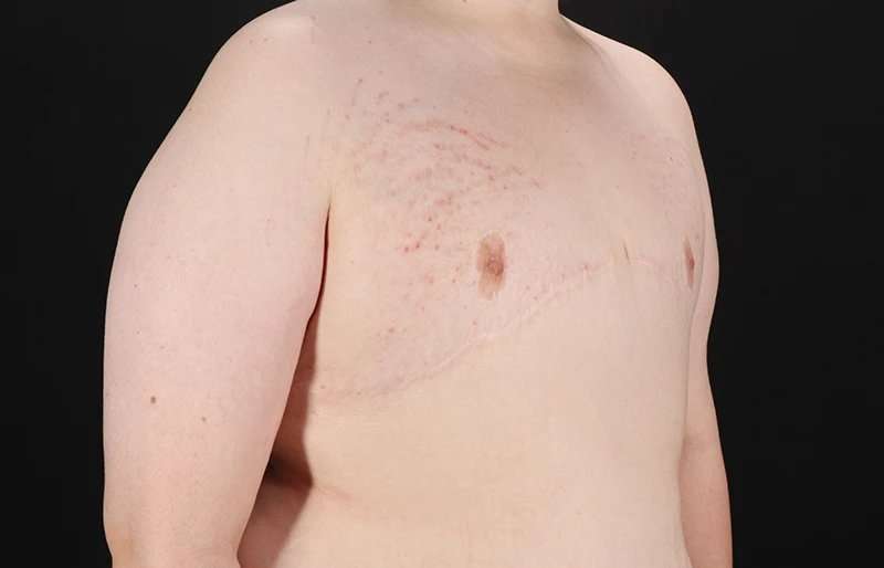 Female To Male Breast Before & After Patient #4130
