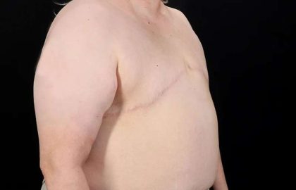 Female To Male Breast Before & After Patient #4141