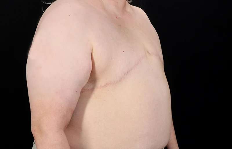 Female To Male Breast Before & After Patient #4141
