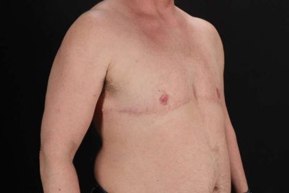 Female To Male Breast Before & After Patient #4152