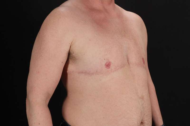 Female To Male Breast Before & After Patient #4152