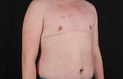 Female To Male Breast Before & After Patient #4163