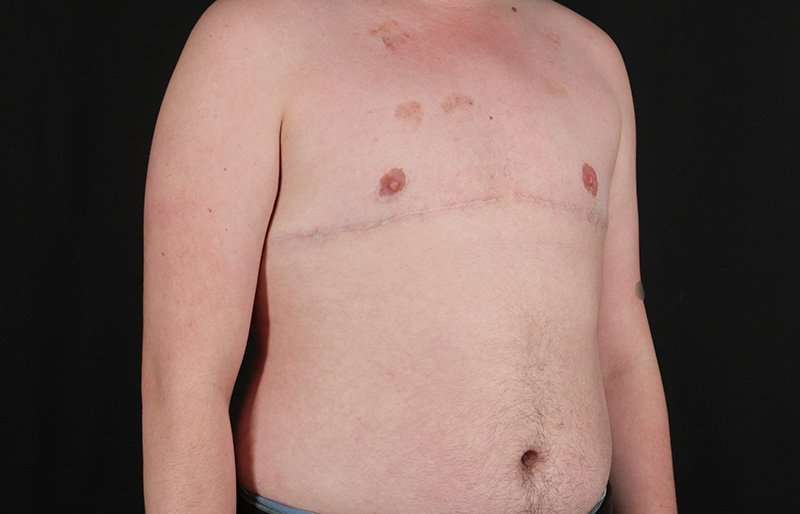 Female To Male Breast Before & After Patient #4163