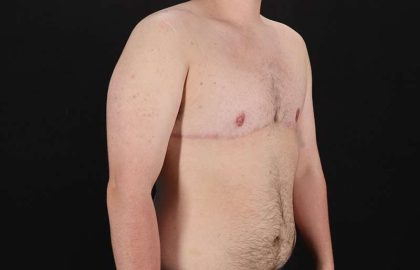 Female To Male Breast Before & After Patient #4174