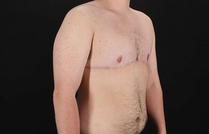 Female To Male Breast Before & After Patient #4174