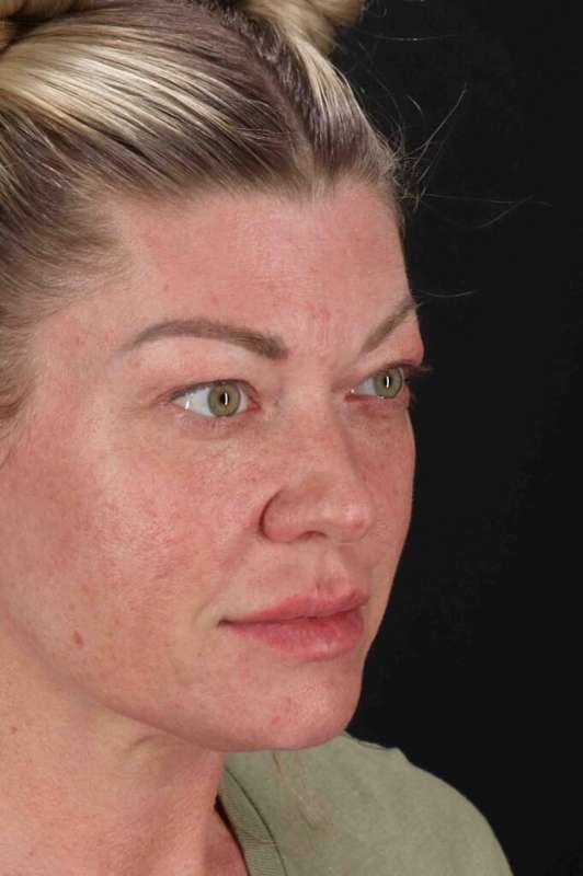 Fat Grafting To The Face Before & After Patient #4232