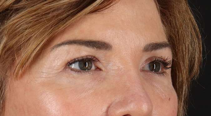 Blepharoplasty (Eyelid Surgery) Before & After Patient #4316