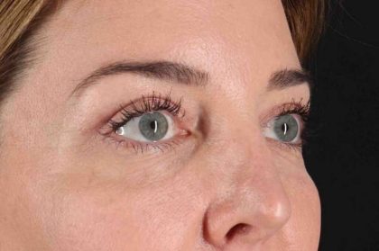 Blepharoplasty (Eyelid Surgery) Before & After Patient #4338