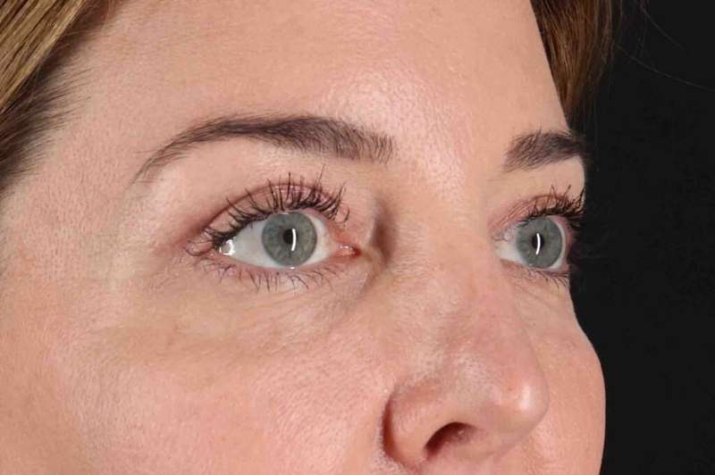 Blepharoplasty (Eyelid Surgery) Before & After Patient #4338