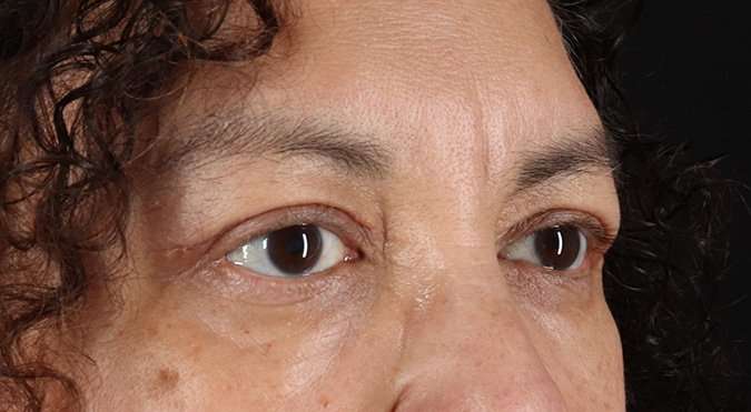 Blepharoplasty (Eyelid Surgery) Before & After Patient #4349