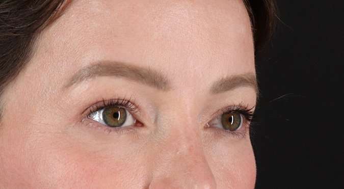 Blepharoplasty (Eyelid Surgery) Before & After Patient #4360
