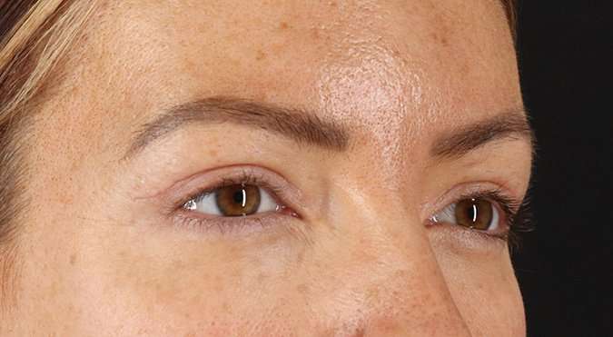 Blepharoplasty (Eyelid Surgery) Before & After Patient #4371