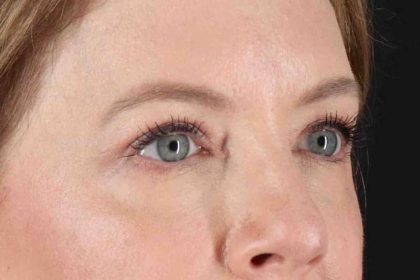 Blepharoplasty (Eyelid Surgery) Before & After Patient #4382