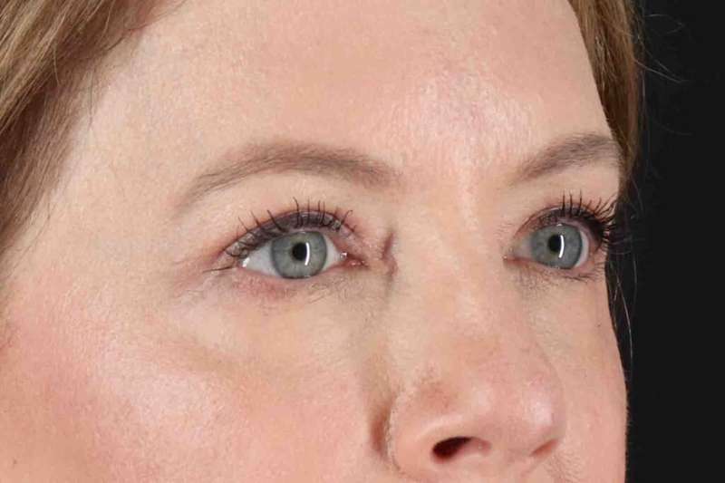 Blepharoplasty (Eyelid Surgery) Before & After Patient #4382