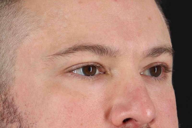 Blepharoplasty (Eyelid Surgery) Before & After Patient #4393