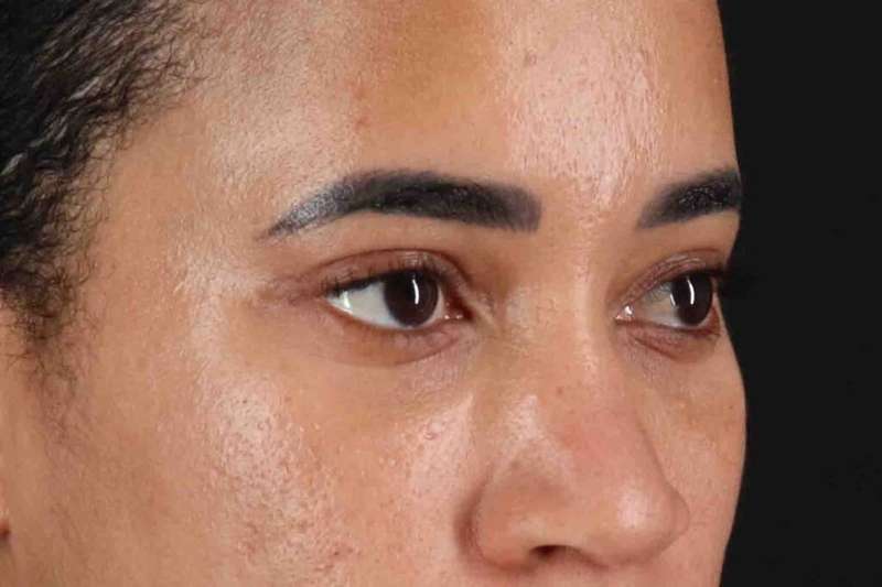 Blepharoplasty (Eyelid Surgery) Before & After Patient #4404