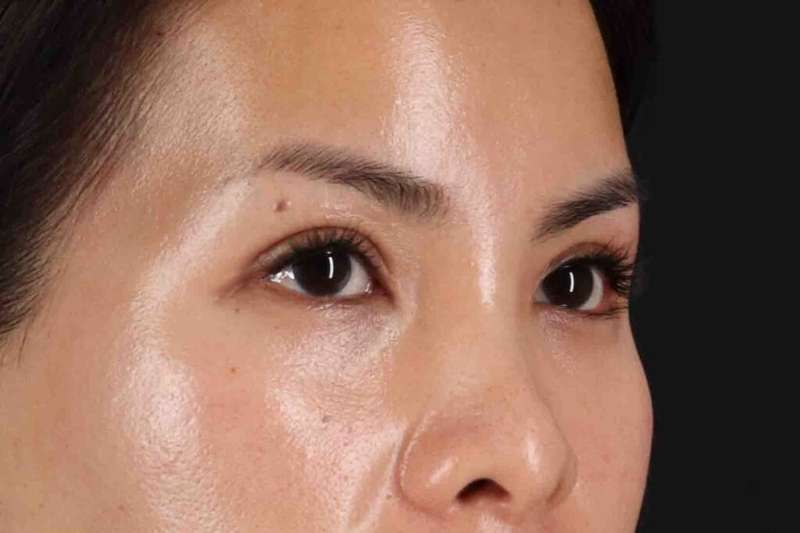 Blepharoplasty (Eyelid Surgery) Before & After Patient #4415