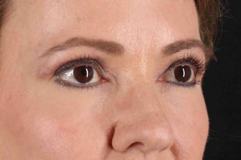 Blepharoplasty (Eyelid Surgery) Before & After Patient #4426
