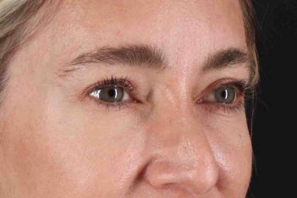Blepharoplasty (Eyelid Surgery) Before & After Patient #4437