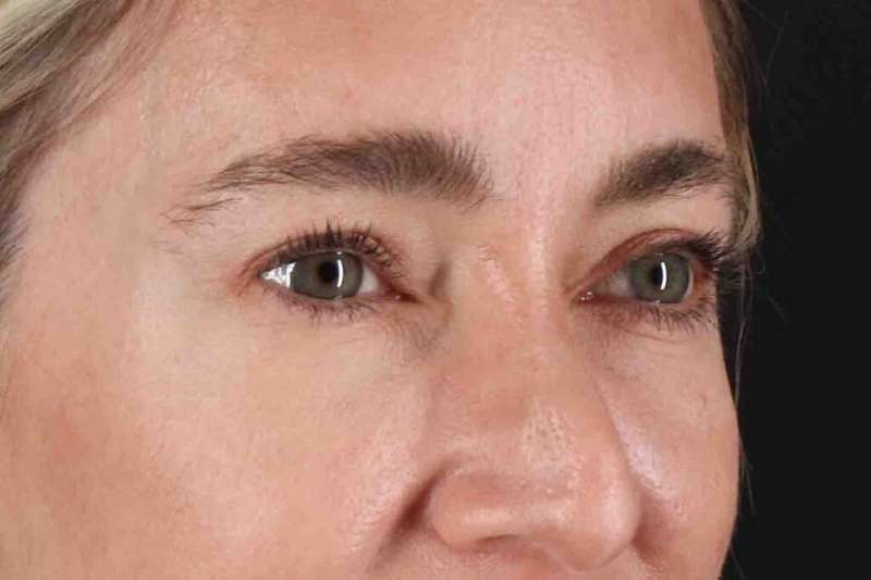 Blepharoplasty (Eyelid Surgery) Before & After Patient #4437