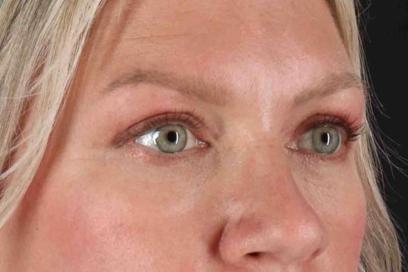 Blepharoplasty (Eyelid Surgery) Before & After Patient #4448