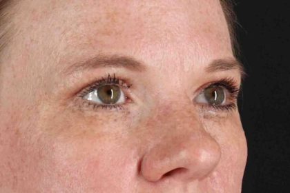 Blepharoplasty (Eyelid Surgery) Before & After Patient #4459