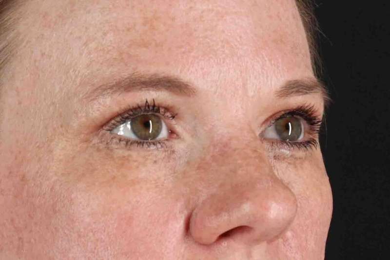 Blepharoplasty (Eyelid Surgery) Before & After Patient #4459