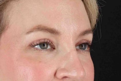 Blepharoplasty (Eyelid Surgery) Before & After Patient #4470