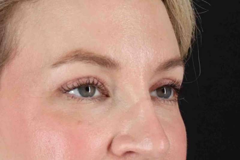 Blepharoplasty (Eyelid Surgery) Before & After Patient #4470