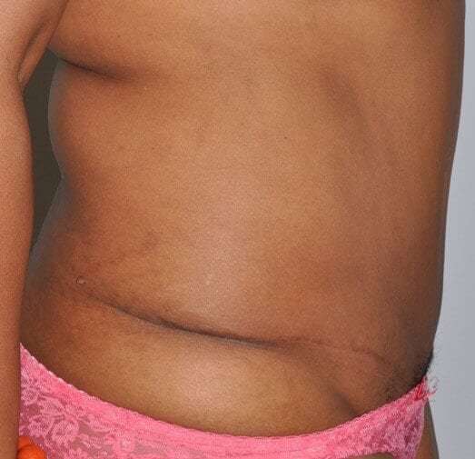Abdominoplasty (Tummy Tuck) Before & After Patient #920