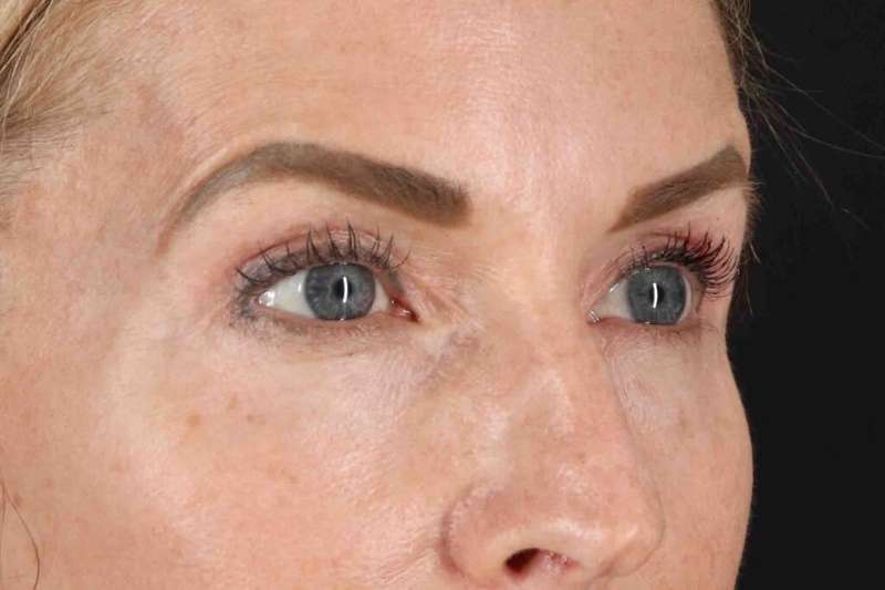 Blepharoplasty (Eyelid Surgery) Before & After Patient #4481