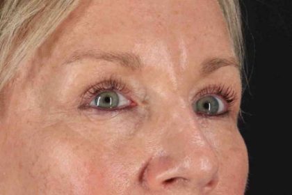 Blepharoplasty (Eyelid Surgery) Before & After Patient #4492