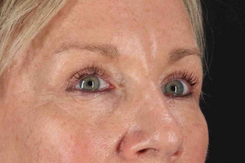 Blepharoplasty (Eyelid Surgery) Before & After Patient #4492