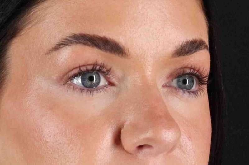 Blepharoplasty (Eyelid Surgery) Before & After Patient #4503
