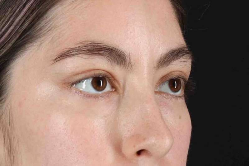 Blepharoplasty (Eyelid Surgery) Before & After Patient #4514