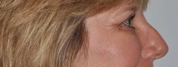 Blepharoplasty (Eyelid Surgery) Before & After Patient #4546