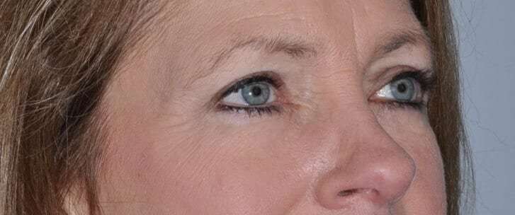 Blepharoplasty (Eyelid Surgery) Before & After Patient #4553