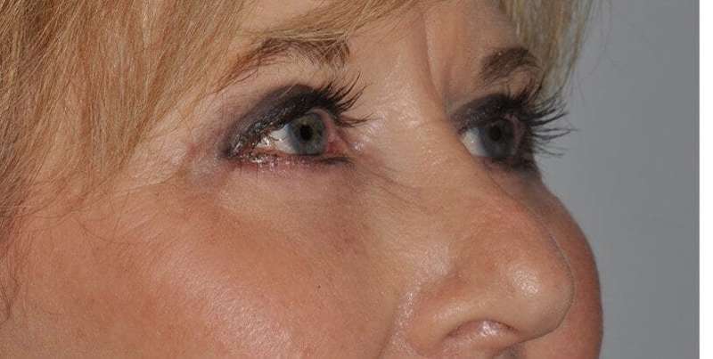 Blepharoplasty (Eyelid Surgery) Before & After Patient #4560