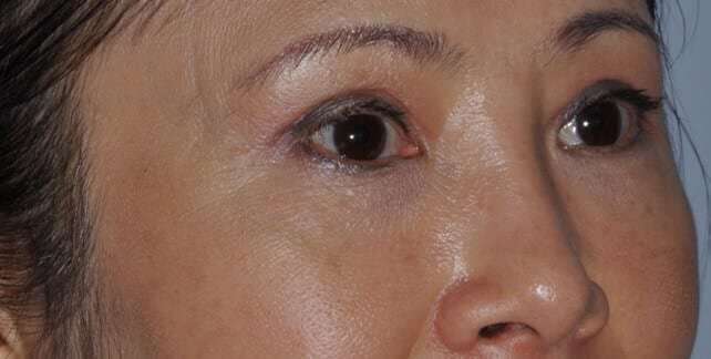 Blepharoplasty (Eyelid Surgery) Before & After Patient #4567